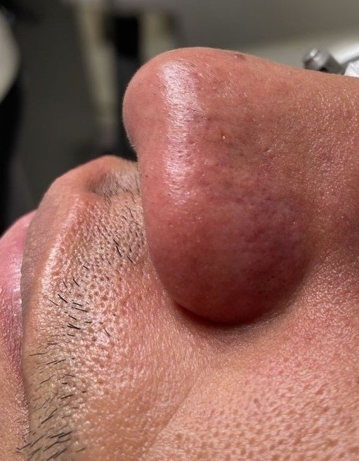 TRATAMENTO DE LESÕES VASCULARES FACE DEPOIS