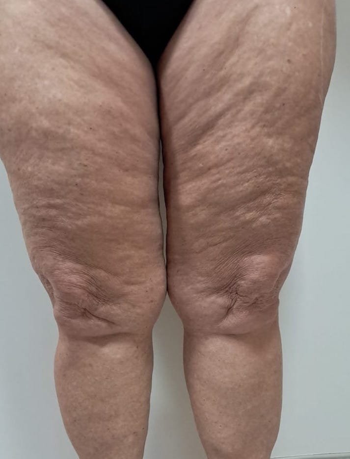 TRATAMENTO DE LIPEDEMA ANTESss TRATAMENTO DE LIPEDEMA ANTESss