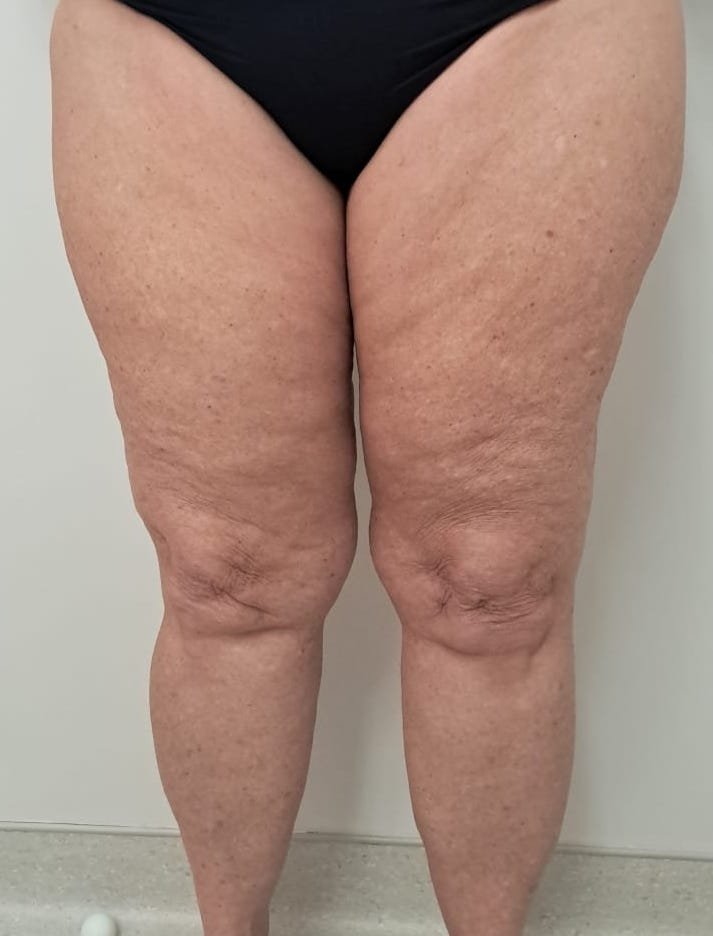 TRATAMENTO DE LIPEDEMA DEPOISs TRATAMENTO DE LIPEDEMA DEPOISs