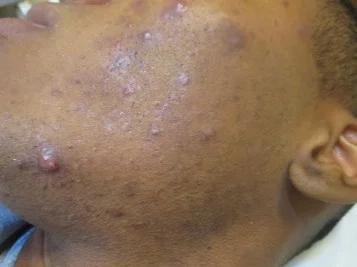 TRATAMENTO-FOLICULITE-FACE-ANTESsss