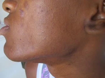 TRATAMENTO-FOLICULITE-FACE-POSsss