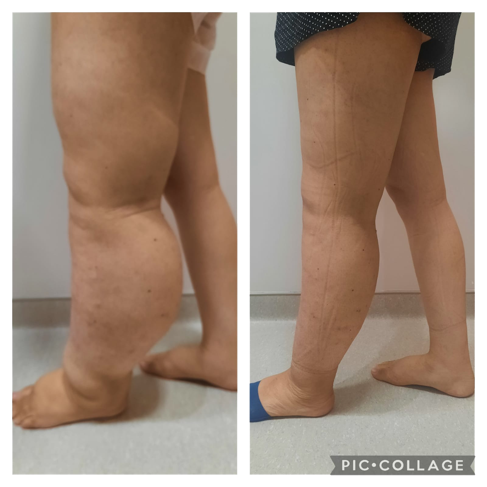 TRATAMENTO linfedema 1 copiar