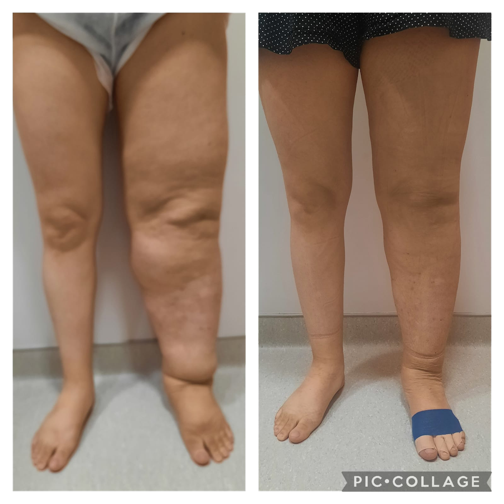TRATAMENTO linfedema 2 copiar