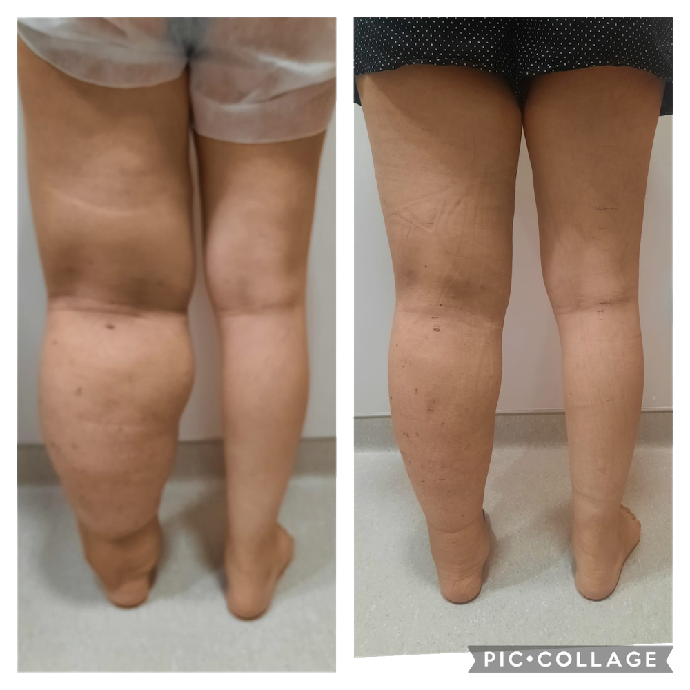 TRATAMENTO linfedema 3 copiar