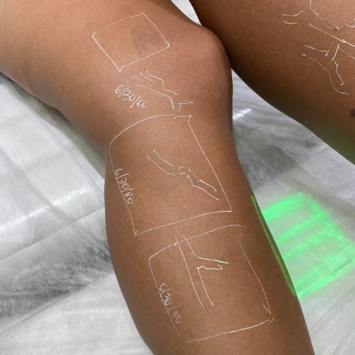CURSO LASER3